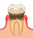 歯周病(経度)